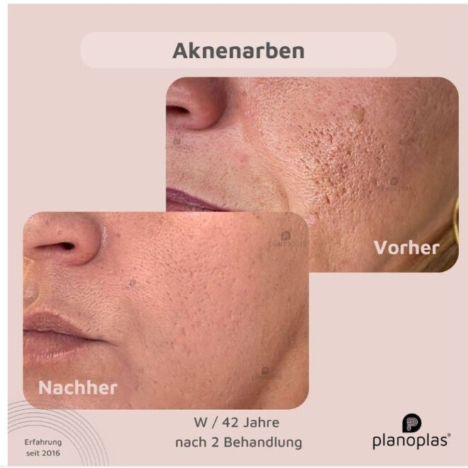 Planoplas Vorher-Nachher-Beispiel bei Aknenarben
