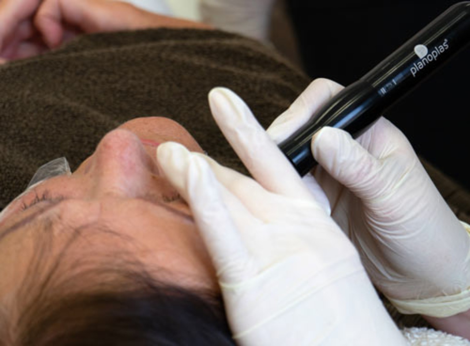 Planoplas Behandlung an der Mundpartie