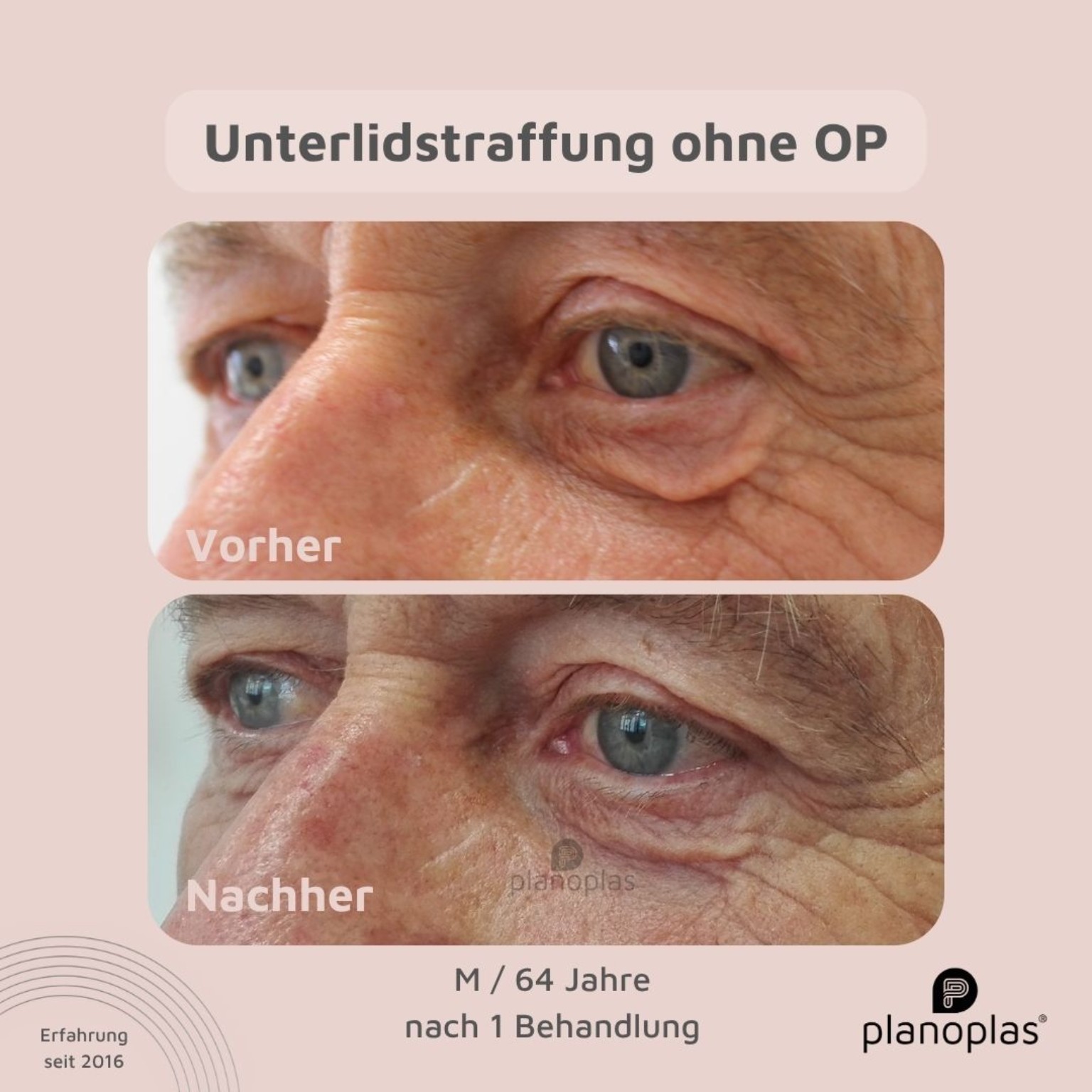 Planoplas Vorher-Nachher-Beispiel einer Unterlidstraffung bei einem Mann